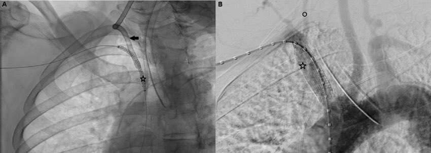 Alternatives to this? If you are lucky enough to diagnose your patient before it’s massive bleeding, you can go for endovascular stenting of the innominate artery; either with retrograde carotid approach or via brachial approach. COVERED STENT will do the job nicely. No drama !