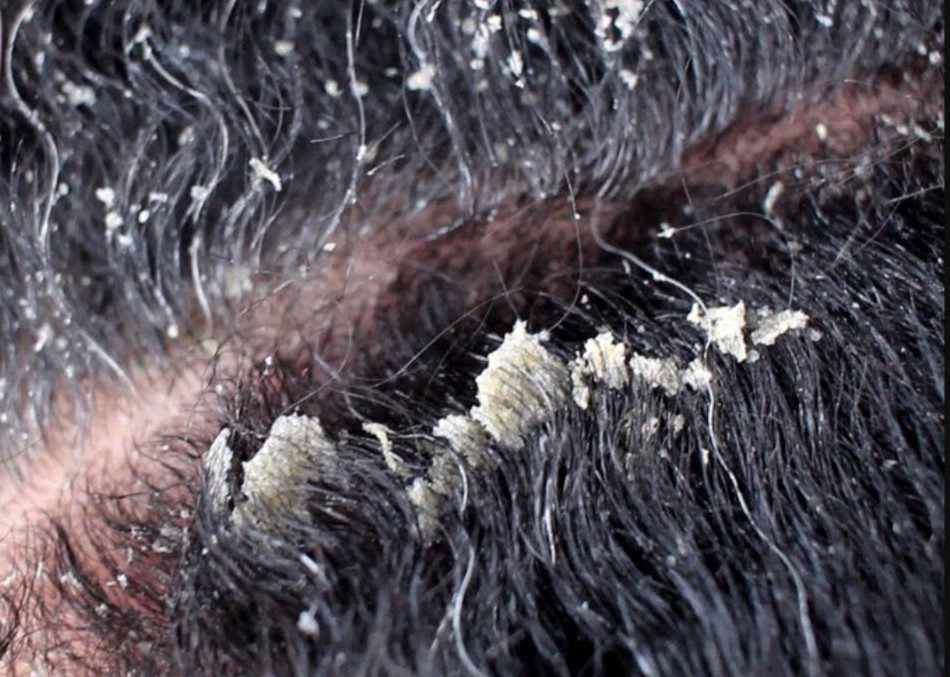 Cure Dandruff for Life!!
WATCH:  youtu.be/SVqDO3PSeG0

#dandruff #seborrheicdermatitis #itchyscalp