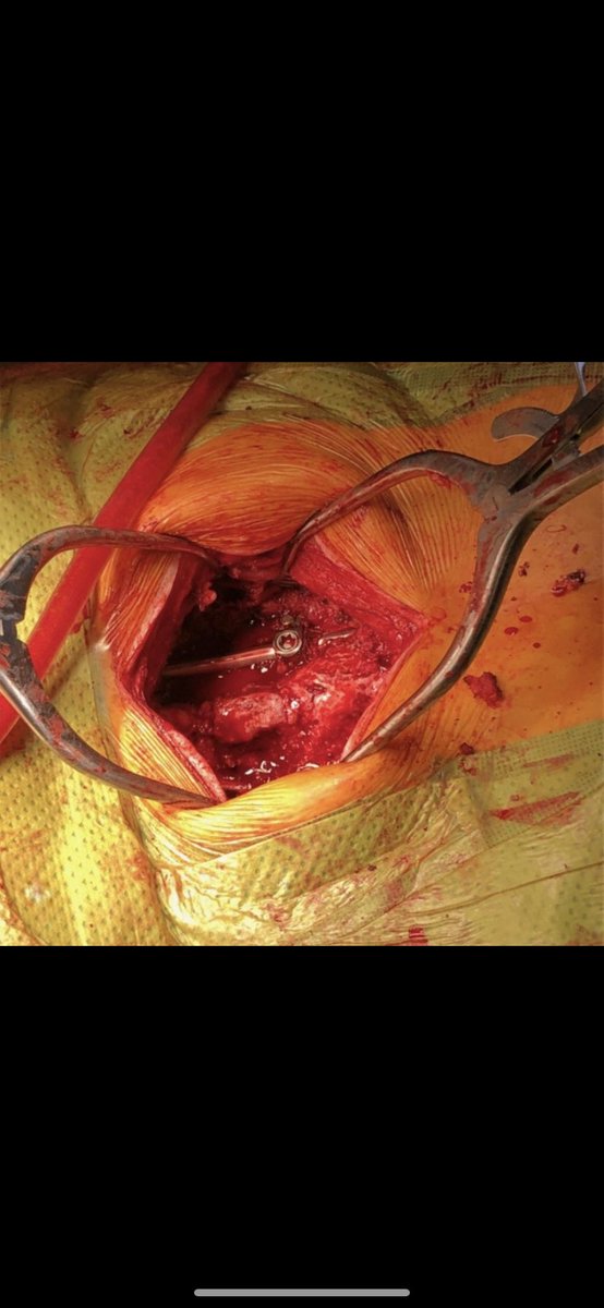 bradystorm2's tweet photo. @JeffreeStar $BSTEP98    Most people wont believe me but I had my surgeon take this photo during my third spinal fusion. I’ve had T1-L5 fused and need some help with bills. Anything would be appreciated. Much love to all. Stay safe❤️ https://t.co/hAukZCu6eo