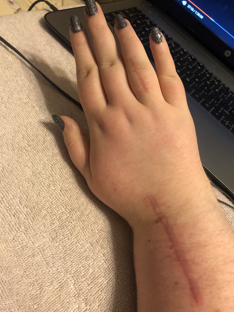 cw injury + scarringi realized i shared some shit from my accident but i haven’t posted my healed up scars? behold.