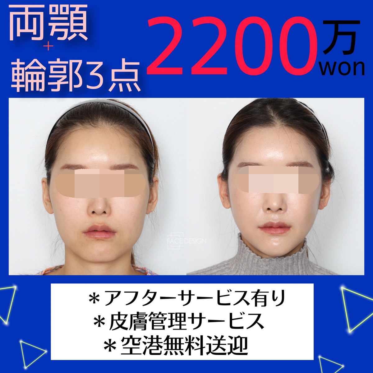 facedesign6's tweet photo. 口ごぼ❣
治せます❣
FACEDESIGNなら何でもできる！❣
術後の２か月❣
#輪郭3点　#顔面　#輪郭　#無顎　#上顎　#下顎　#両���　#セットバック　#エラ削り　#出っ歯　#口ゴボ #バッカルファット　#縦幅　#オトガイ　#噛み合わせ #しゃくれ顎　#うけくち　#受口　#オルチャン　#ソウル　#韓国　#東京 https://t.co/Y5T4U6kWQQ
