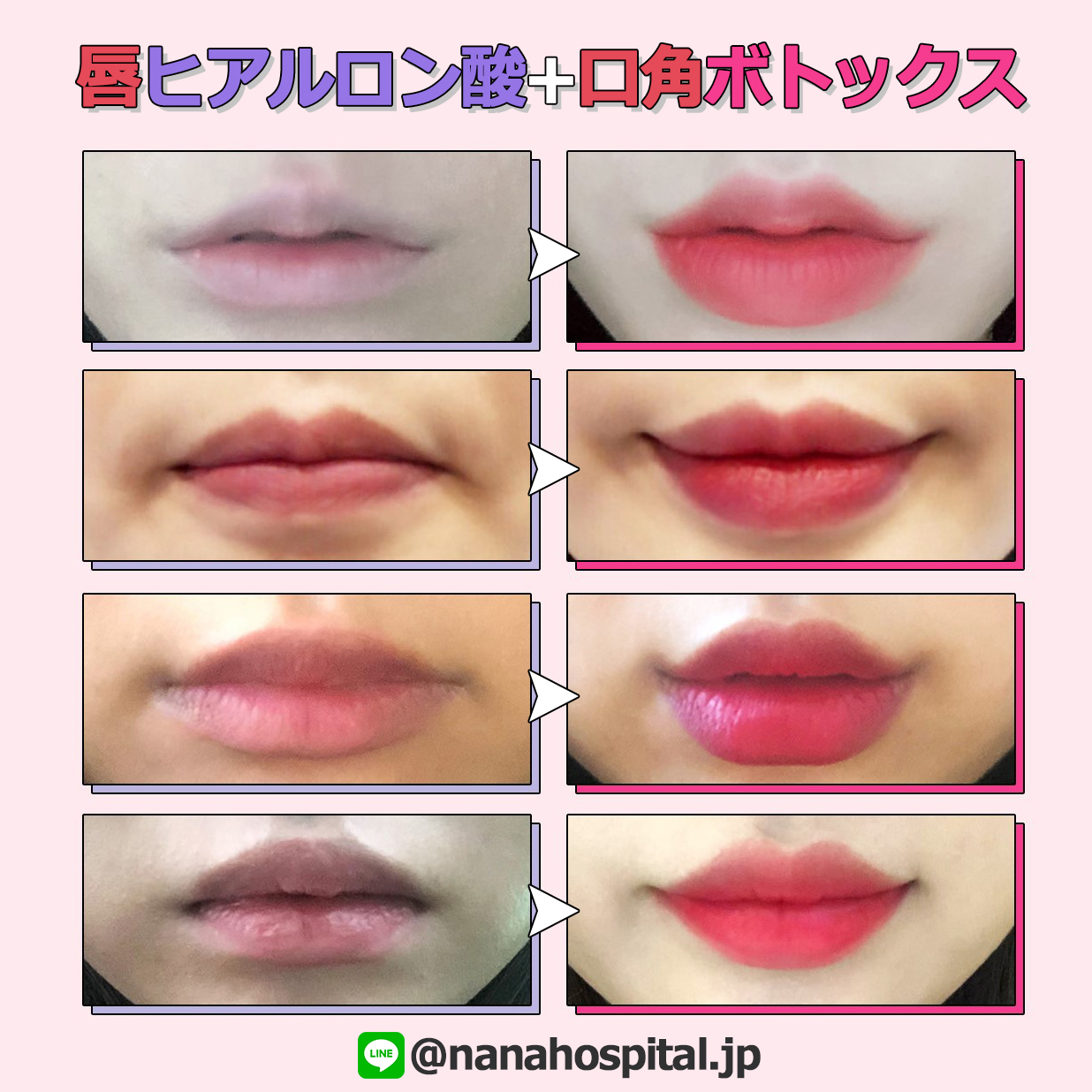 韓国整形nana美容外科 V Twitter Nana唇フルセット 私もこんな唇になりた い そんな願いを叶えてみませんか 韓国整形 唇ヒアルロン酸 ボトックス ご相談は お気軽にnana公式lineまで お問い合わせ下さい 公式line T Co Uktu5b4nbb キスしたく 韓国整形nana美容外科 V Twitter Nana唇フルセット 私もこんな唇になりた い そんな願いを叶えてみませんか 韓国整形 唇ヒアルロン酸 ボトックス ご相談は お気軽にnana公式lineまで お問い合わせ下さい 公式line T Co Uktu5b4nbb キスしたく
