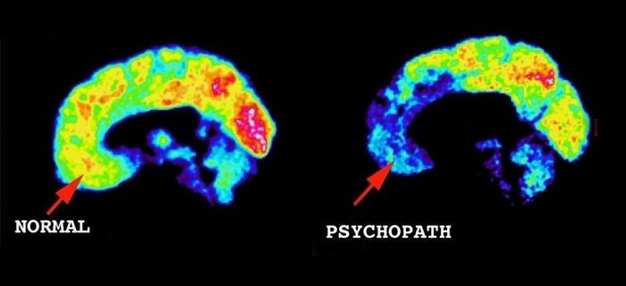 53) Perhaps the most important takeaway is that NONE of this is “conspiracy theory.” This is occurring almost entirely due to a factual, well-documented and devastatingly hostile mental deficiency – psychopathy – that goes largely undetected by the vast majority of normal people.