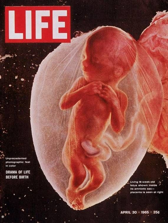 The “experts” told us in 1973 that the unborn child was just a blob of tissue and an abortion was just like getting your tonsils removed. Forget this picture published on the cover of Life Mag in 1965.