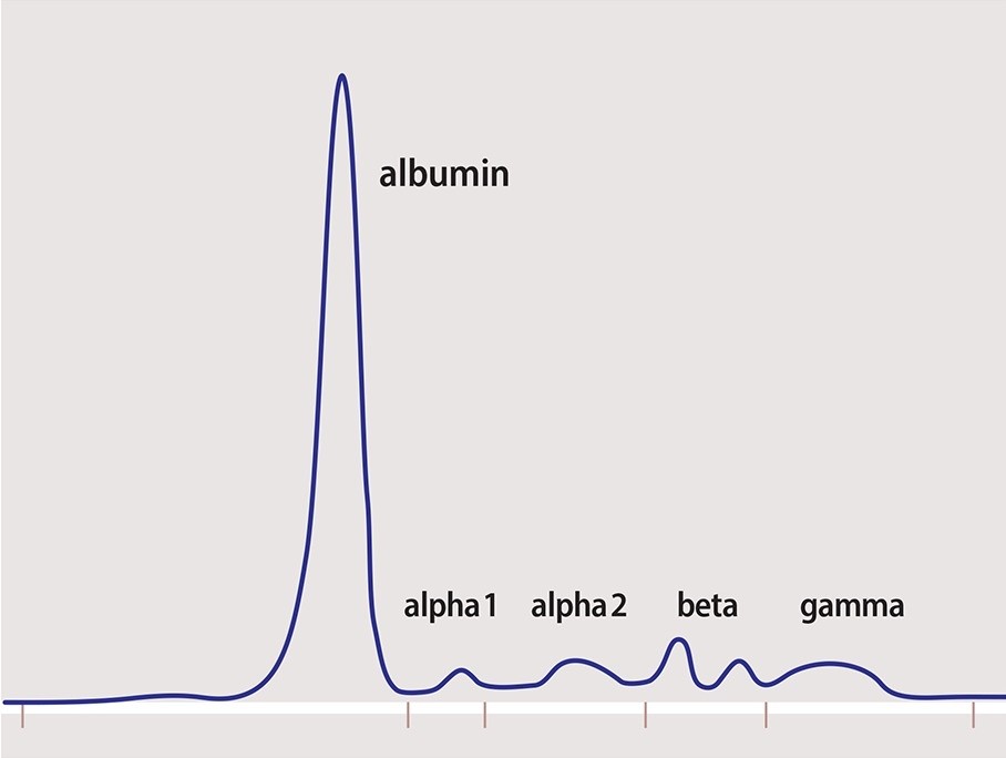 2/ This is what a normal SPEP pattern looks like. Albumin (60%) - globulins (40%). Normal A:G ratio 1.5-2.5.Globulins comprise alpha 1, alpha 2, beta 1, beta 2 and gamma globulin portions.