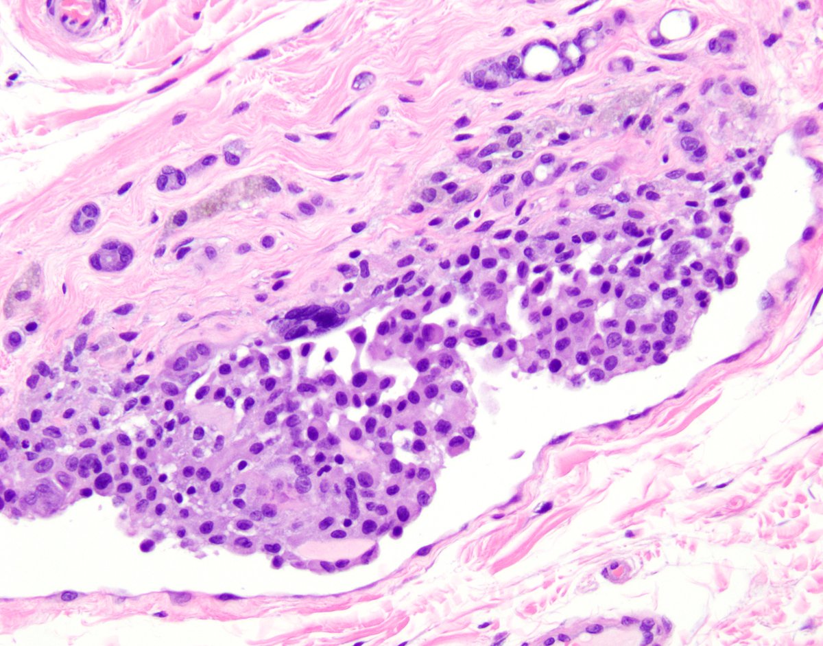 confirmatory test for mesothelioma