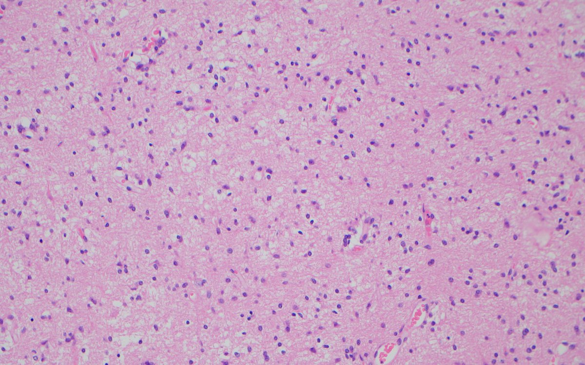 bitar_mireille's tweet photo. Diffuse astrocytic glioma IDH-wildtype with TERT mutation. Classification ? https://t.co/rzMo9jdRDr