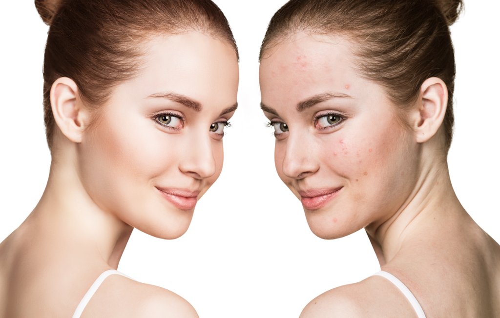 Glendale_Derm's tweet photo. If you are struggling with acne we are here to help. The dermatologists at Glendale Dermatology provide acne care that is tailored to the specific needs of each individual patient. Visit our website to learn more: https://t.co/tU2aZxFjIm https://t.co/FybaWwUywc