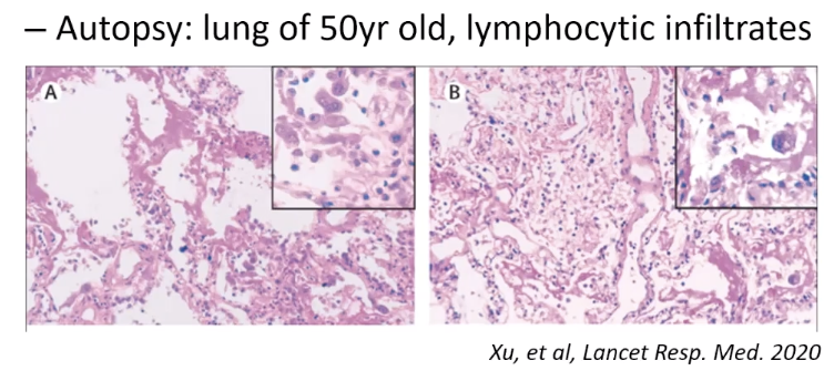 We also know that in some of the cases where one looked to be doing okay and then crashed, we're seeing lymphocytic infiltrates. In this autopsy, you're seeing a lack of airways a lot of T cells.  #FarberCOVID19