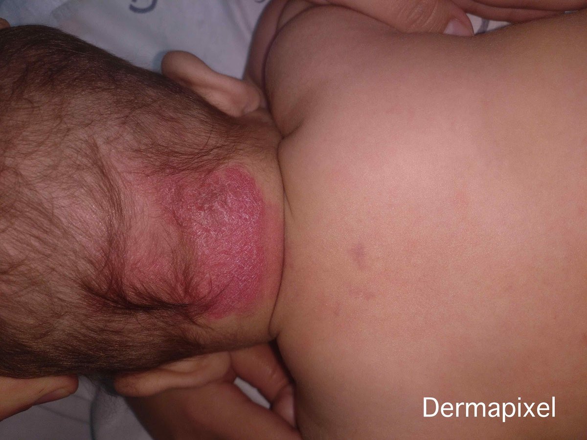 ¿Habíais visto alguna vez un fenómeno de Meyerson (eccematización) en una mancha salmón? Dedicado a los pediatras de por aquí, quienes seguro se mueren de ganas de volver a ver a sus niños con normalidad. #pediatría #dermatología 
dermapixel.com/2020/04/fenome…