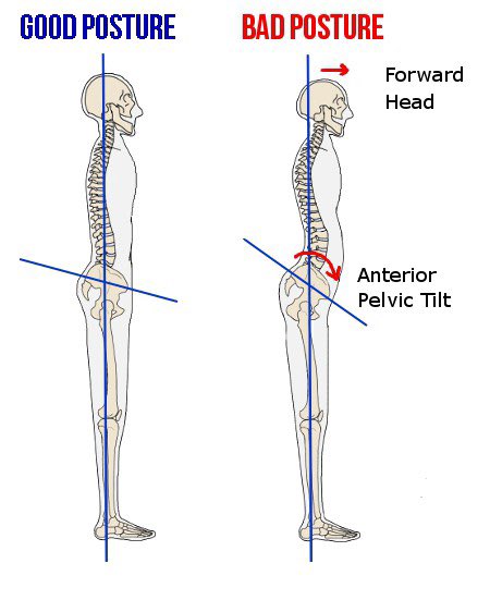 posterior hip/thigh musculature causes the body to adapt to this orientation of hip flexion.A hip that has full extension while standing directs the force of bodyweight slightly posteriorly. The static equilibrium between gravity and the stretched connective tissues(2/7)