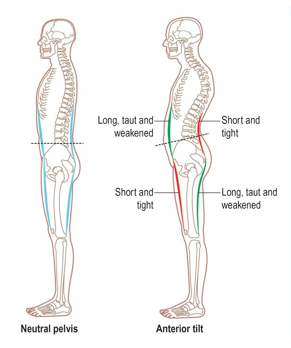 minimize the need for metabolically expensive muscular activation while standing.However, when the hips remain flexed, the forces are redirected anteriorly and now gravity is acting more as a hip flexor.In order to prevent collapse into full knee/hip flexion, active(3/7)