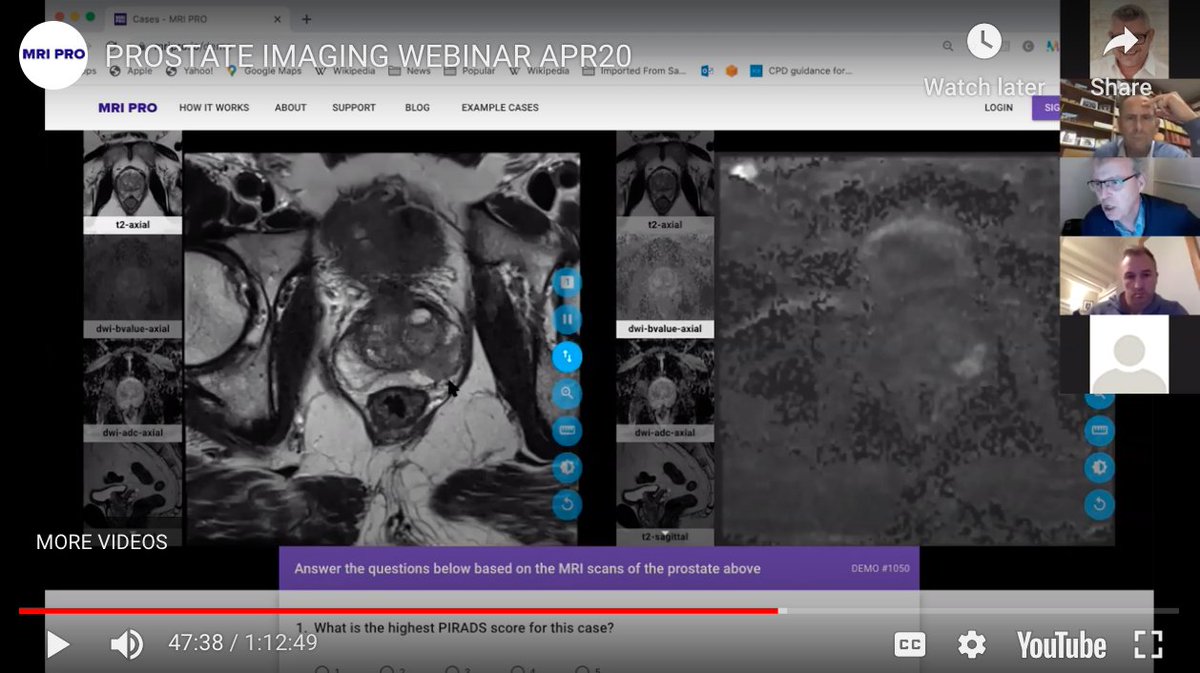 Tune in to our recent 1-hour #Prostate #MRI #Webinar at bit.ly/2VubCzh. Basics in PI-RADS plus real case discussions. For #urologists, #trainees and #radiologists new to #prostateMRI. 
<a href="/USANZUrology/">USANZ</a> <a href="/Uroweb/">European Association of Urology (EAU)</a> <a href="/SIU_urology/">SIU-Urology</a> <a href="/AmerUrological/">Amer. Urol. Assn.</a> <a href="/RadiologyACR/">American College of Radiology</a> #UroSoMe <a href="/MRIPRO1/">MRI PRO</a>