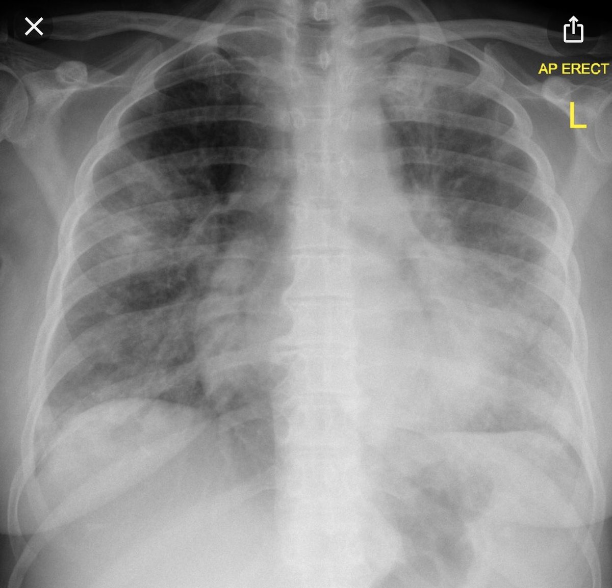 1/  #Ogitorial No25  #COVID1956M transferred after 2 days fevers, diarrhea, cough; traveling salesmen, h/o HtnA okB HFNC 75% RR35110/56 HR 110 on low NED AvpuE T39.5U bil B lines, hyperdynamic LV/RVL Na120, Cr2.3, neut/lymph, CRP400, D-Dimer>1500, Ferritin>5000 pH7.4