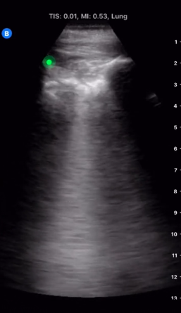 Reflections  #COVID19 nights: as surge wanes + more non-COVID pts, lung US more valuable- COPD/CHF/asthma/PE w/ similar presentations- Subpleural consolidations, thickened/irreg pleural line, focal/multifocal b-linesChat w/  @UltrasoundMD @bedsidesono  http://bit.ly/3bnMPlE 