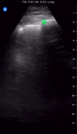 Reflections  #COVID19 nights: as surge wanes + more non-COVID pts, lung US more valuable- COPD/CHF/asthma/PE w/ similar presentations- Subpleural consolidations, thickened/irreg pleural line, focal/multifocal b-linesChat w/  @UltrasoundMD @bedsidesono  http://bit.ly/3bnMPlE 