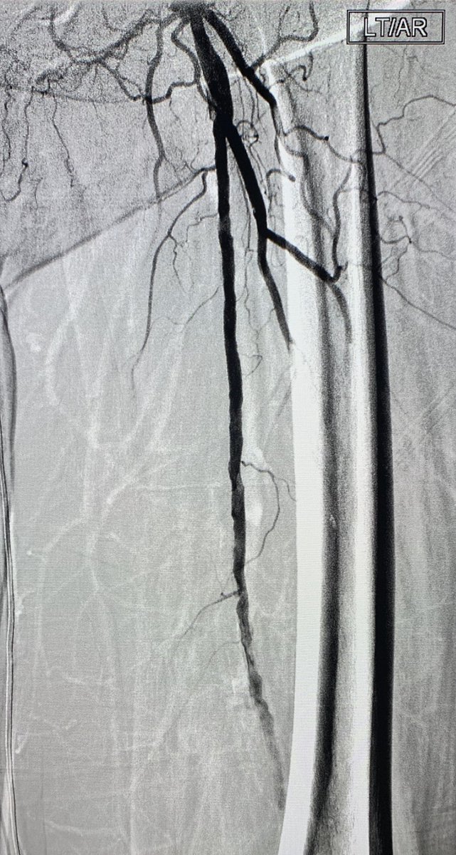 t_intheleadcoat's tweet photo. New onset #Afib with #embolic #ALI treated with @PenVascular #indigo CAT 5. Symptoms resolved.#viablelimb. Success of #aspiration #thrombectomy depends on #clot #consistency. #destination sheath with detachable hub also helps. #irad @SIRspecialists @SIR_ECS #coldleg @pairsmedia https://t.co/5zaBTEFKVv