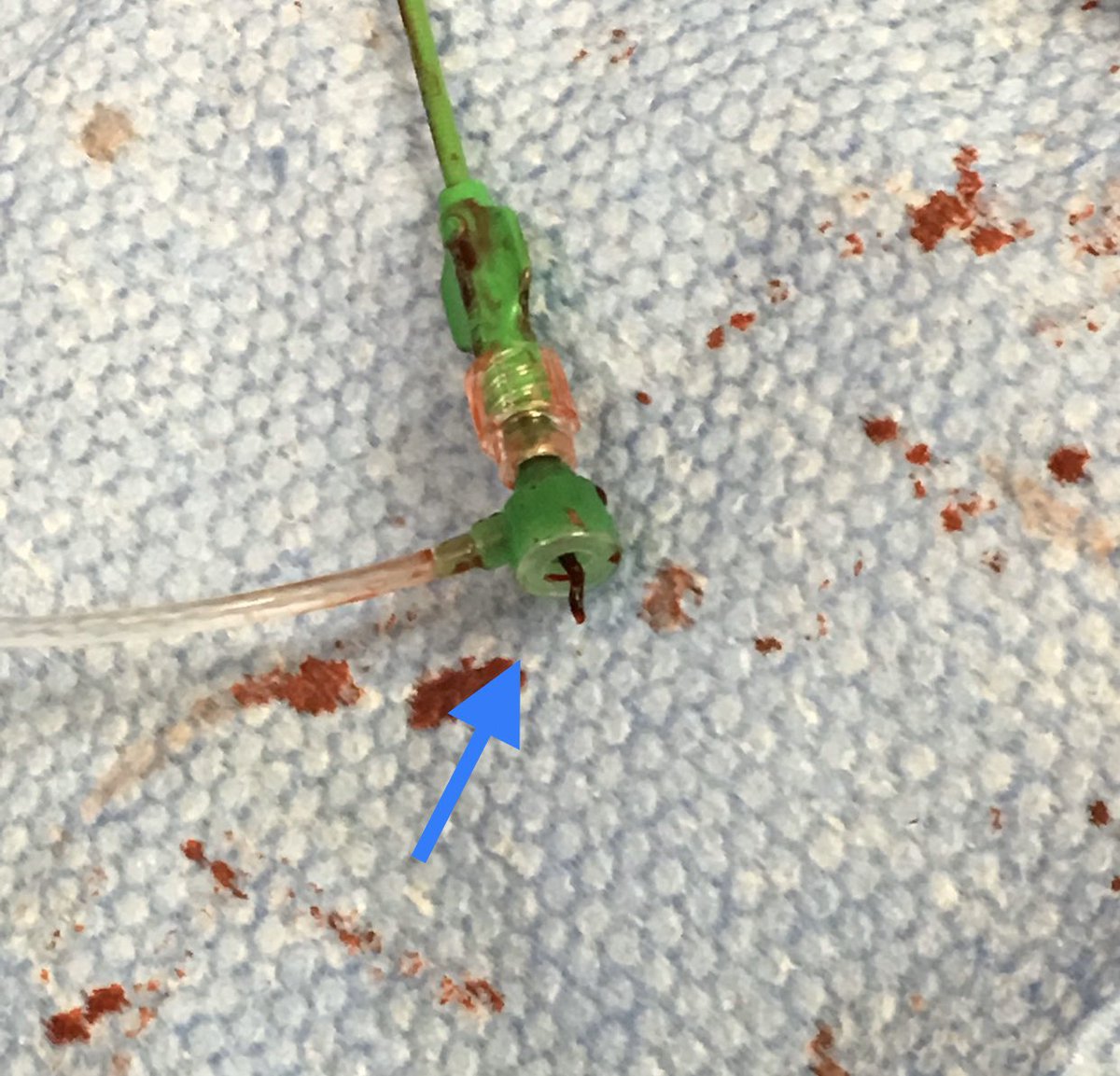 t_intheleadcoat's tweet photo. New onset #Afib with #embolic #ALI treated with @PenVascular #indigo CAT 5. Symptoms resolved.#viablelimb. Success of #aspiration #thrombectomy depends on #clot #consistency. #destination sheath with detachable hub also helps. #irad @SIRspecialists @SIR_ECS #coldleg @pairsmedia https://t.co/5zaBTEFKVv