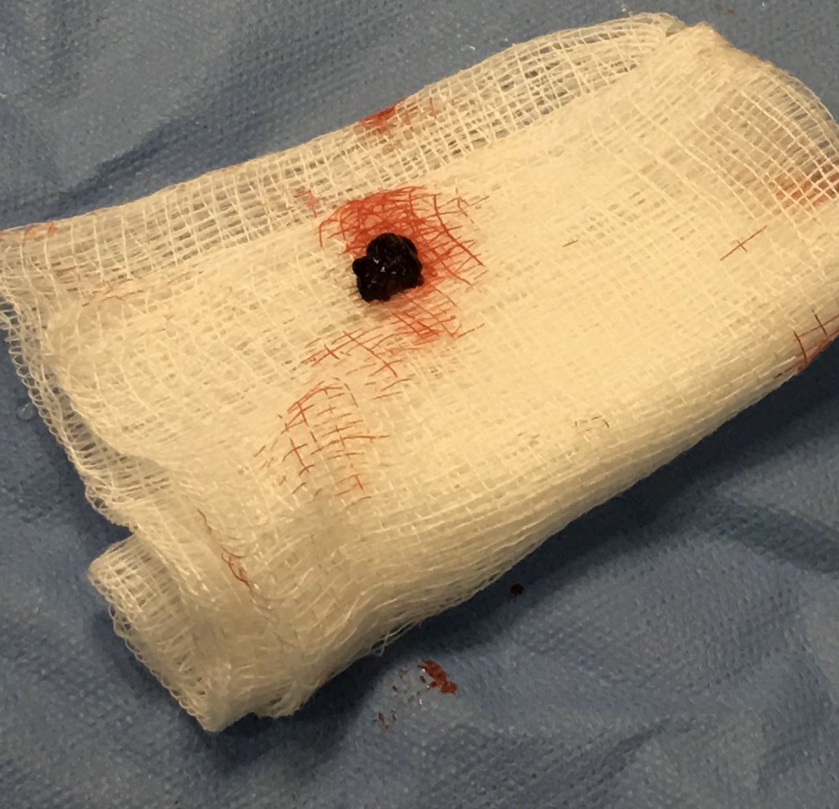 t_intheleadcoat's tweet photo. New onset #Afib with #embolic #ALI treated with @PenVascular #indigo CAT 5. Symptoms resolved.#viablelimb. Success of #aspiration #thrombectomy depends on #clot #consistency. #destination sheath with detachable hub also helps. #irad @SIRspecialists @SIR_ECS #coldleg @pairsmedia https://t.co/5zaBTEFKVv