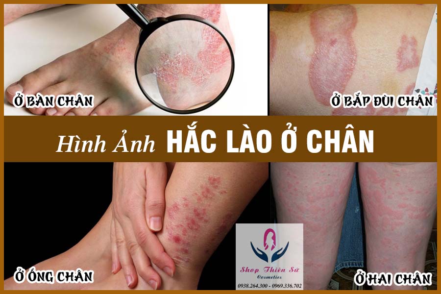 jakata1982's tweet photo. Bệnh hắc lào ở chân là bệnh do lây nhiễm trực tiếp hoặc gián tiếp của con nấm cdermatophytes. Với các triệu chứng nổi bật trên chân như nổi mẩn đỏ và mụn nước li ti trên da. https://t.co/4WABSRvbVS https://t.co/SE05bmpanM