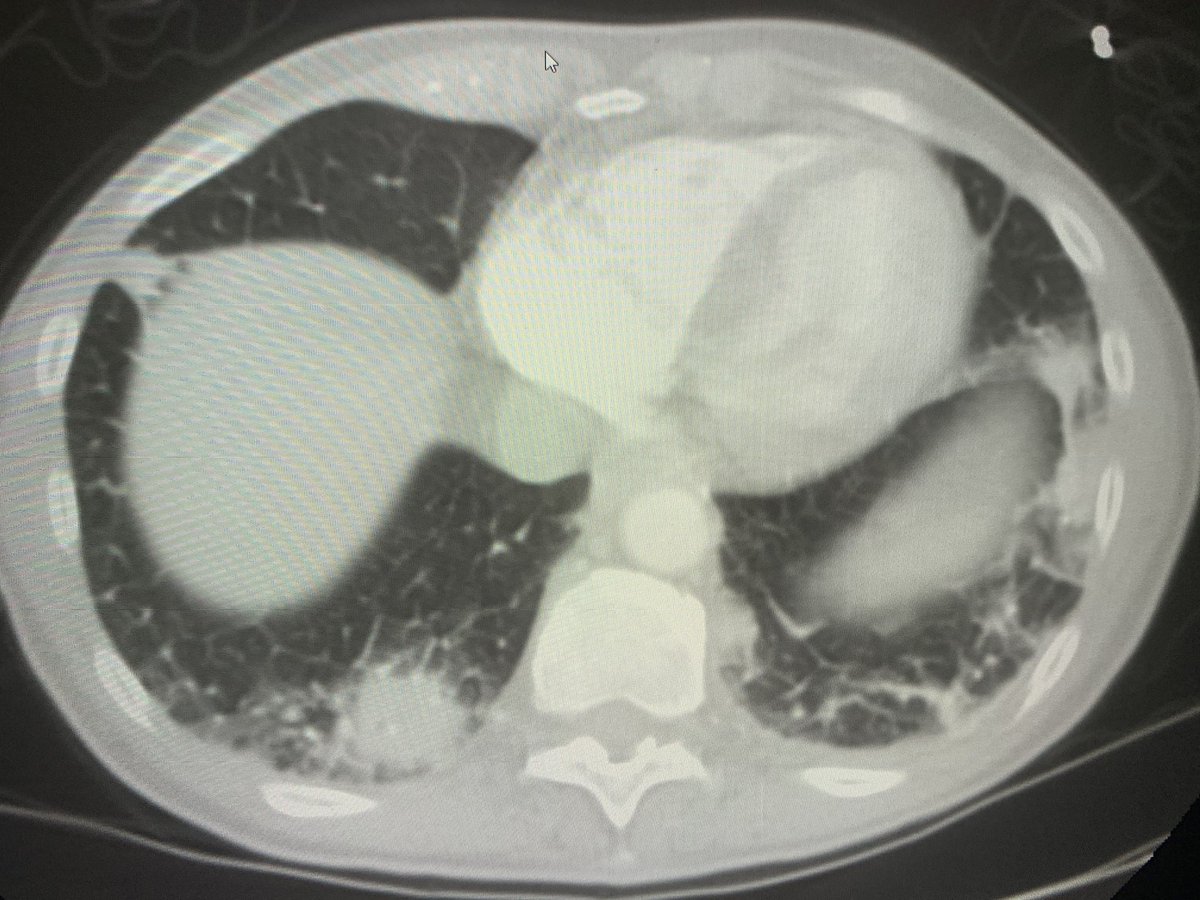 danortizmd's tweet photo. Covid19???? Nah. 104 fever undergoing chemo. New nodules. Nonspecific stuff, but can consider angioinvasive aspergillosis, septic emboli, mets etc. #chestrad #radres #genrad https://t.co/nmml2ANkJT