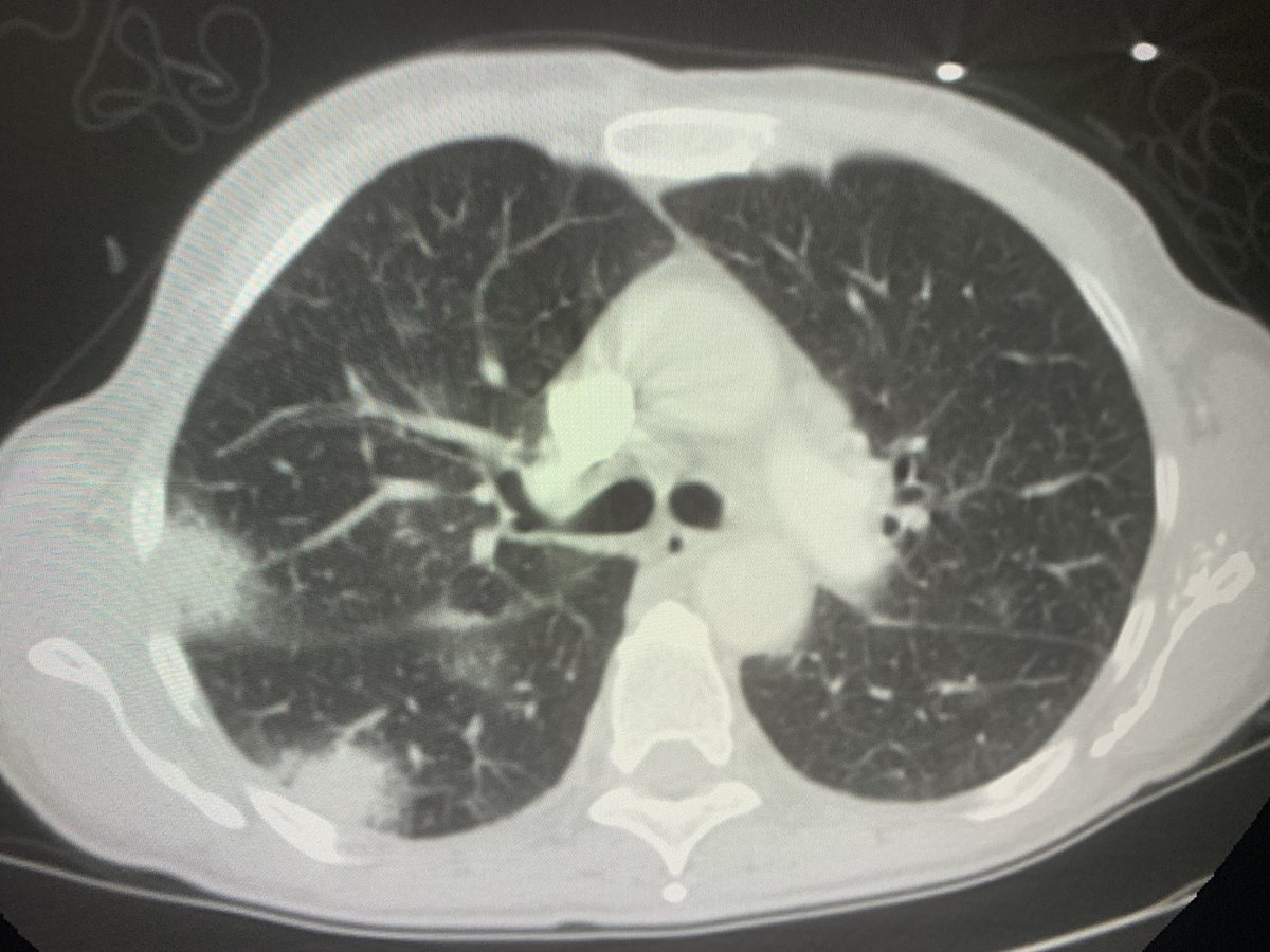 danortizmd's tweet photo. Covid19???? Nah. 104 fever undergoing chemo. New nodules. Nonspecific stuff, but can consider angioinvasive aspergillosis, septic emboli, mets etc. #chestrad #radres #genrad https://t.co/nmml2ANkJT