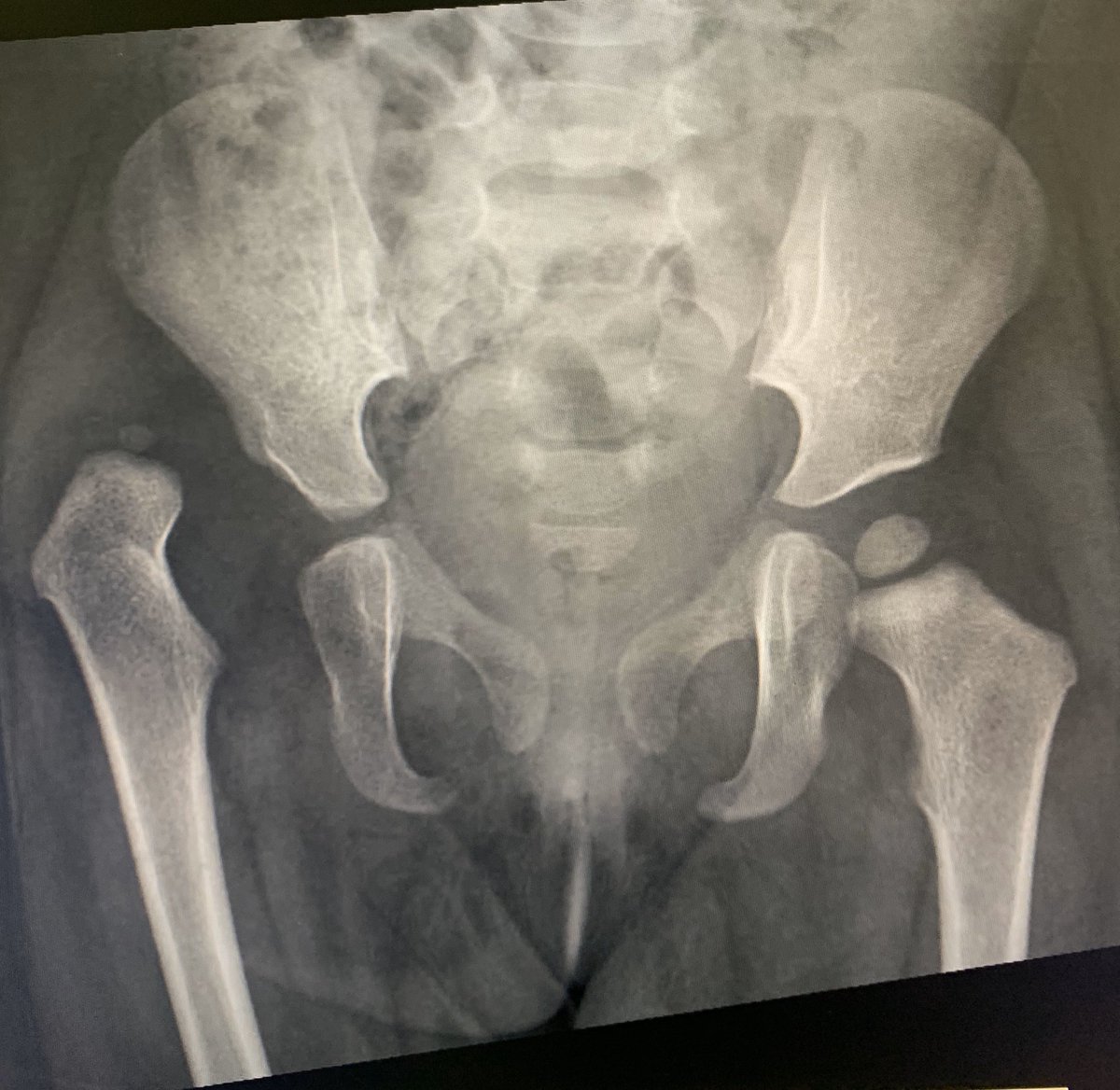 Today’s case: 18 month old child. HX OF FAILED CLOSED REDUCTION AT 9 months of age. Open reduction pelvic osteotomy adductor tenotomy and hip spica done. No tension at reduction so no femoral shortening. I’d like to mention the Saudi experience in this common pathology here=