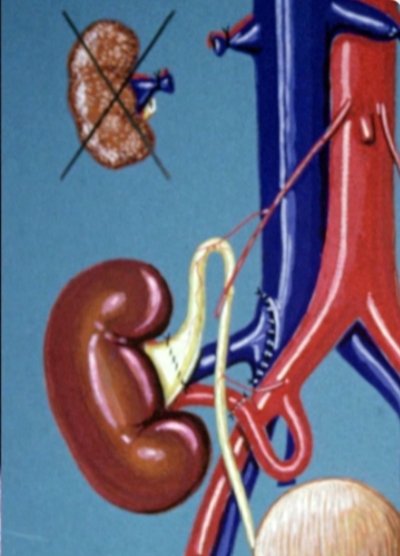 luisfarina2016's tweet photo. Professor José María Gil-Vernet, who died on March 5, 2020, was a strong supporter of producing films for teaching &amp; training other surgeons, who could then reproduce a precise surgical technique. 
See the  colletion available online
https://t.co/MShHAyW4wq

Curated by @Gilvernet https://t.co/zEWYIl6TKk
