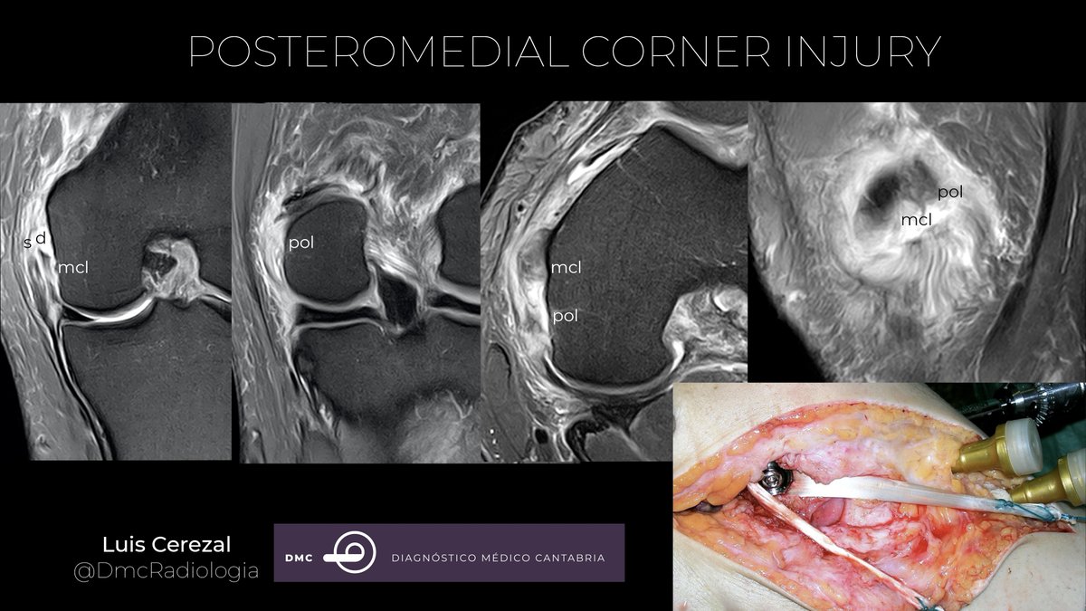 #SMSKfromTheCave Injuries to MCL and posteromedial corner of the knee are common, usually associated with cruciate ligament injuries. These injuries can cause valgus and anteromedial rotational instability (AMRI) and require surgical reconstruction procedures