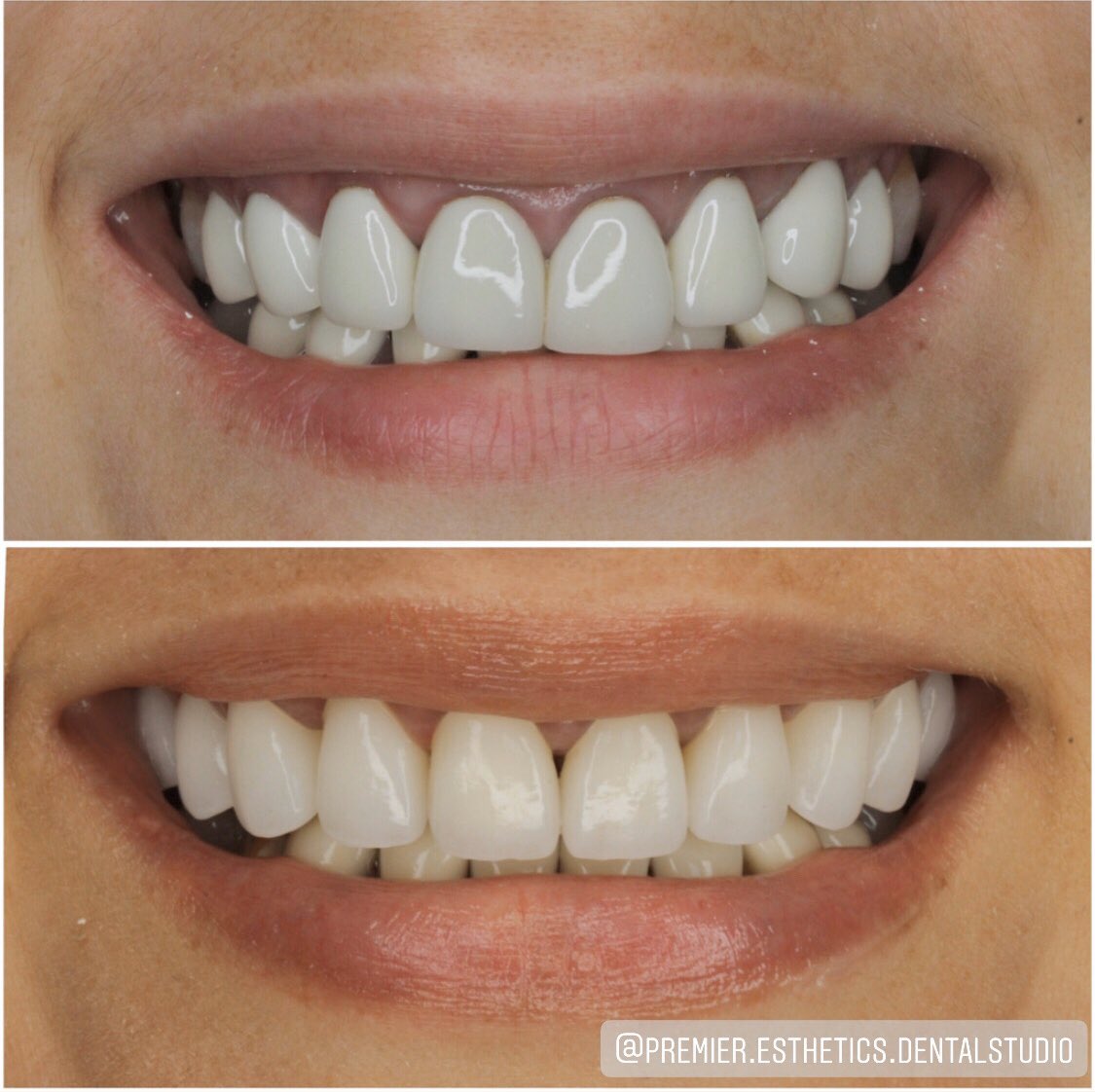 Металл шаазан бүрээсийг циркон бүрээсээр солив.