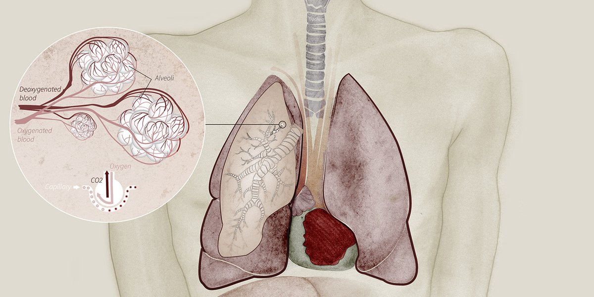 Down the windpipe and through bronchial tubes in the lung, the disease affects tiny air sacs called alveoli. The walls of the air sacs become damaged and inflamed, reducing the oxygen supply to the blood and leaving the patient struggling for breath.