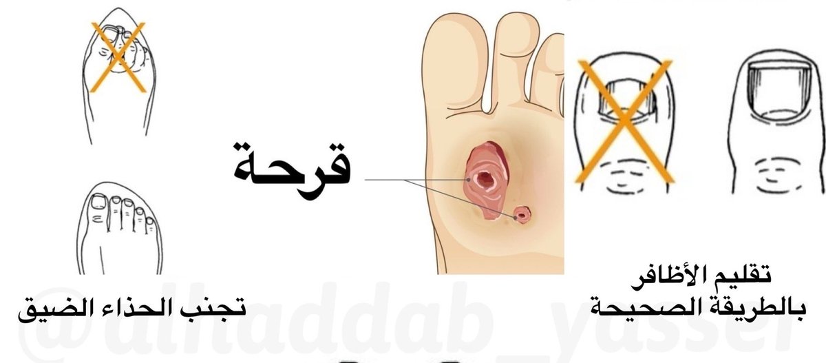 Alhaddab_Yasser's tweet photo. 🦶🏼القدم السكرية: 

بمناسبة حلول شهر رمضان المبارك والتحديات التي تواجه مصاب السكري للتحكم بمعدل السكر في نطاق متوازن.

أقدم لكم نصائح خاصة لحماية القدم من التعرض لمضاعفات المرض.

|| الوقاية خيرٌ من العلاج ||

دمتم بصحة، و تقبل الله منا ومنكم صالح الأعمال 🌙

#صوت_الطبيب
@co_aw1 https://t.co/Ctx6pTWwXT