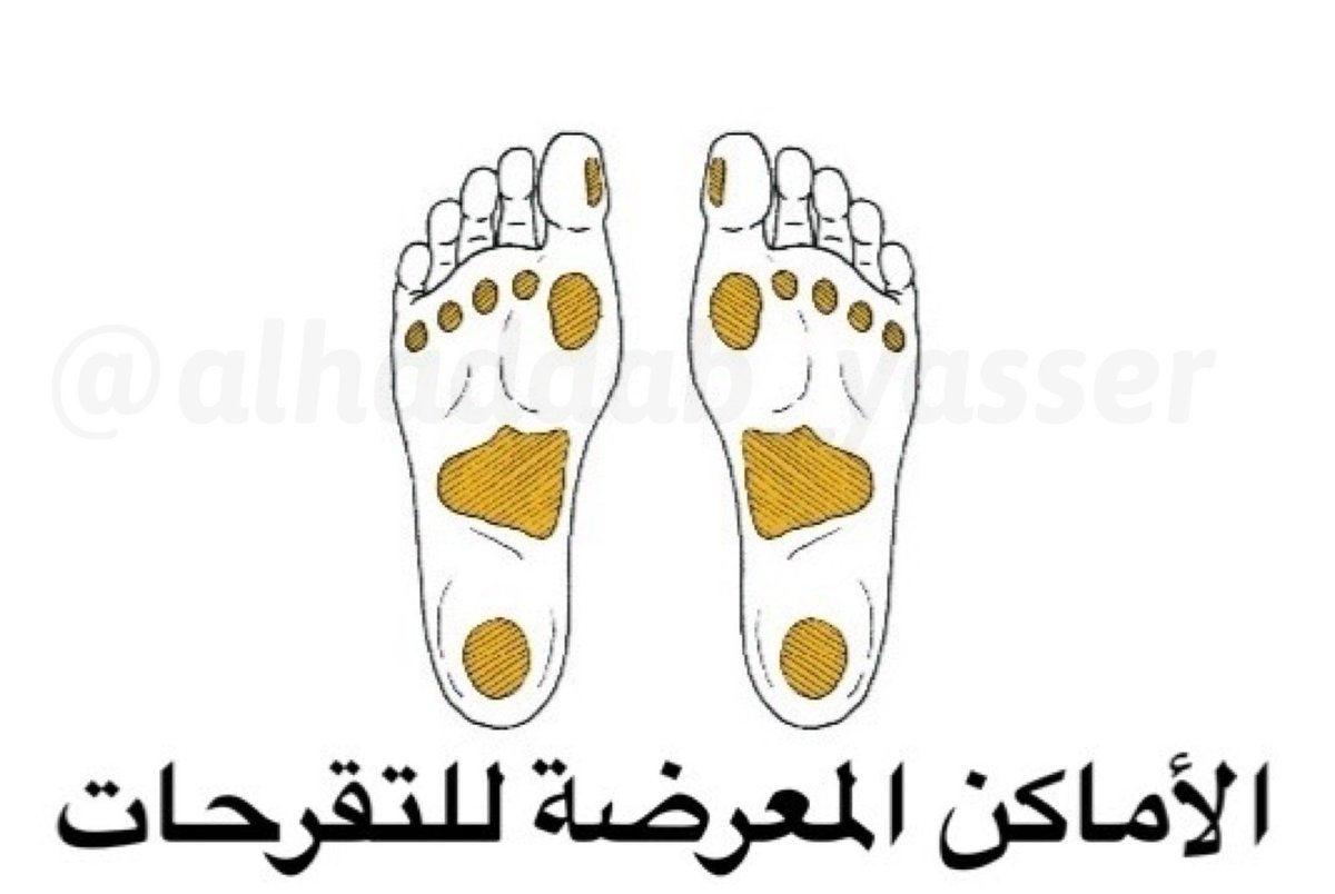 Alhaddab_Yasser's tweet photo. 🦶🏼القدم السكرية: 

بمناسبة حلول شهر رمضان المبارك والتحديات التي تواجه مصاب السكري للتحكم بمعدل السكر في نطاق متوازن.

أقدم لكم نصائح خاصة لحماية القدم من التعرض لمضاعفات المرض.

|| الوقاية خيرٌ من العلاج ||

دمتم بصحة، و تقبل الله منا ومنكم صالح الأعمال 🌙

#صوت_الطبيب
@co_aw1 https://t.co/Ctx6pTWwXT