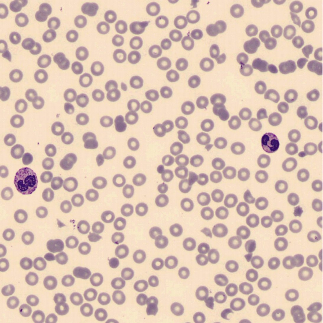 DavidCrzG's tweet photo. Thursday cytology challenge
#cytology
#peripheralbloodsmear
#cellsconfination
#cellavision
#donotpanic https://t.co/4XpNFUOnE8