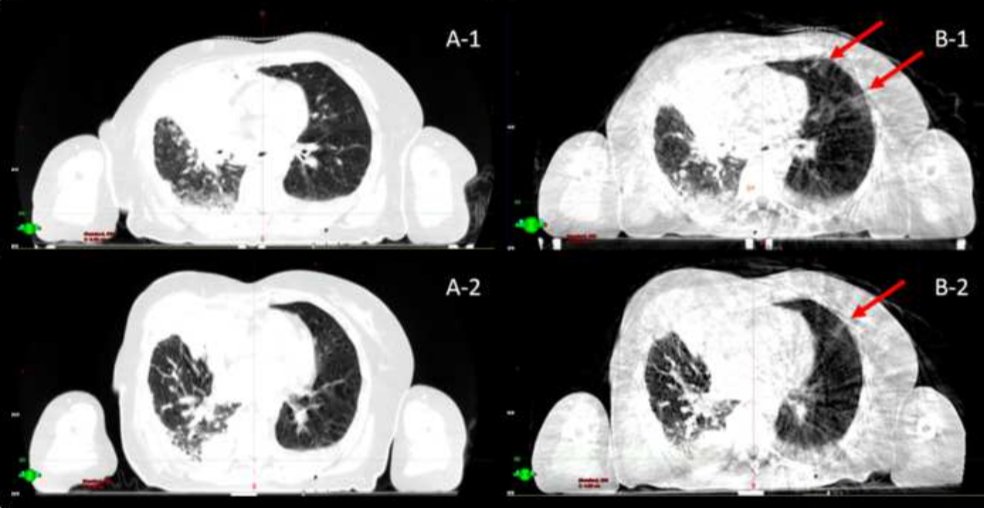 Effectiveness of #CBCT in early detection of #COVID lung disease. Pay attention to thoracic RT treatments! #radonc