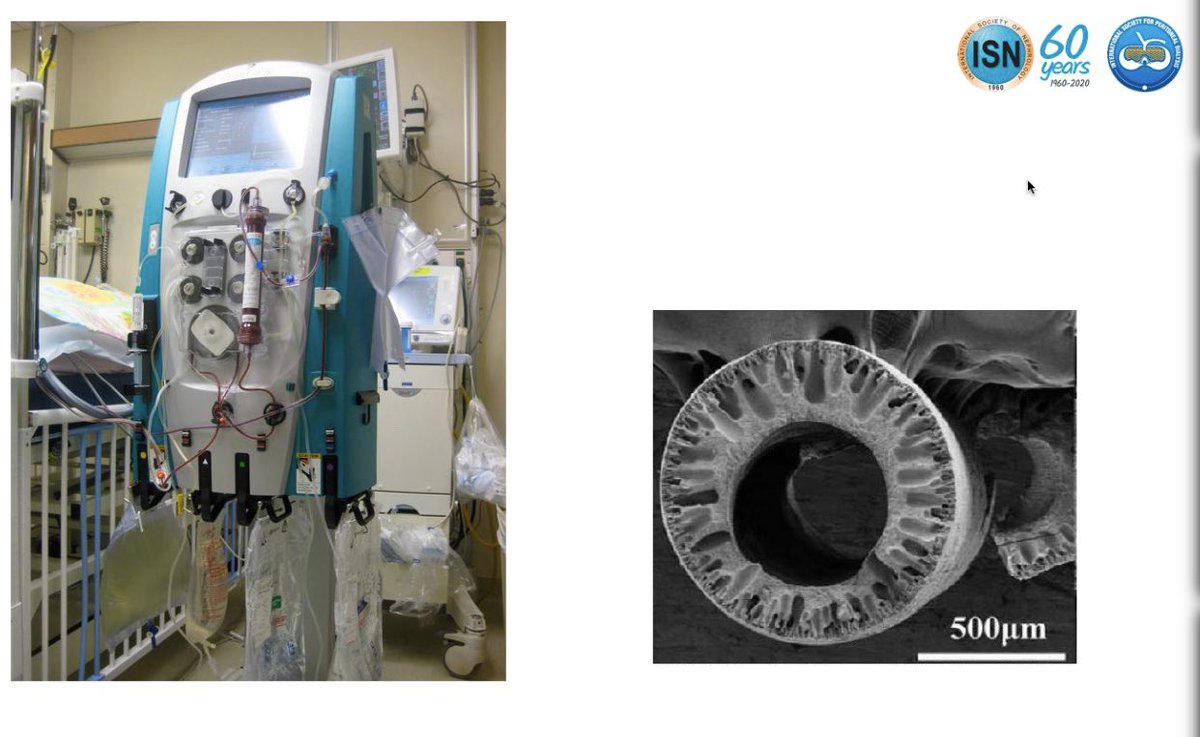  https://www.kidney-international.org/article/S0085-2538(20)30369-0/fulltextAbnormal clotting leads to early filter clotting and line problems with CRRT and HD