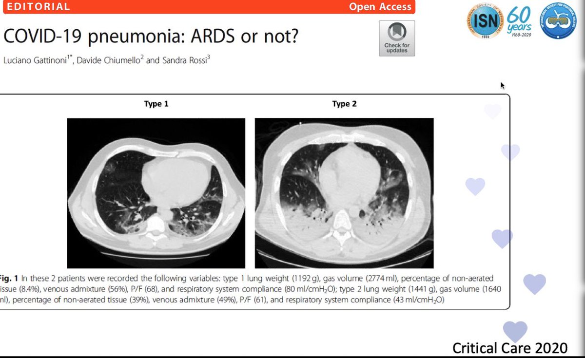 2 types of lung involvement in COVID19 pneumonia Type 1 Near normal pulmonary compliance with isolated viral pneumonia type 2 -Decreased pulmonary compliance https://ccforum.biomedcentral.com/articles/10.1186/s13054-020-02880-zProne ventilation sometimes helpfulFluid balance not easy – even in the ICU