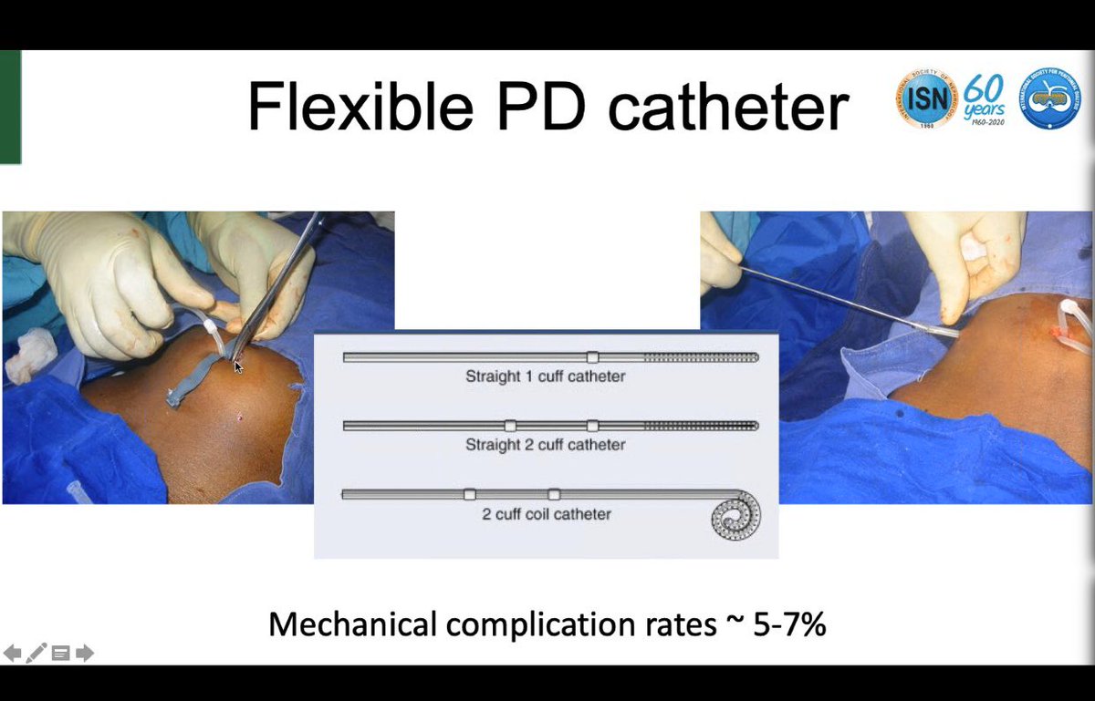 what catheter ?