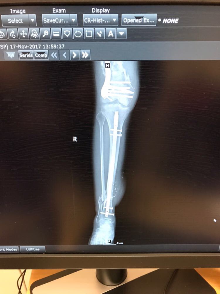 stafglaze's tweet photo. @charleyboorman My right femur,tib &amp; fib all saved by #nhsamaizing https://t.co/ouW5XAwKpl