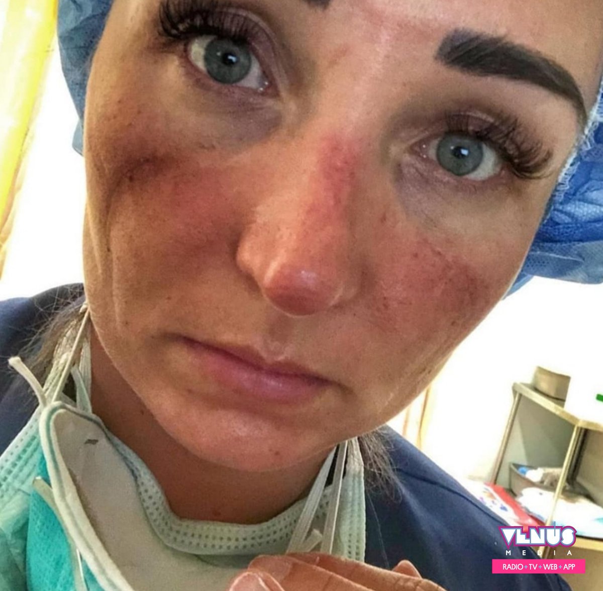 venusmedia's tweet photo. 😷 Profesionales de la salud de todas partes del mundo comparten sus fotos mostrando cómo sus rostros son afectados por utilizar equipos de protección personal mientras diariamente se exponen al virus, tratando a pacientes contagiados. #covid19 https://t.co/nUr2qq0Wzq