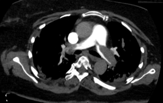 RadiologyEditor's tweet image. RADIOLOGY New:  PE by CT in 30% of #COVID19 patients, single institution observation, positive in all patients with D-dimer &amp;gt;2600 µg/L bit.ly/3bzYm1A #radiology @radiology_rsna