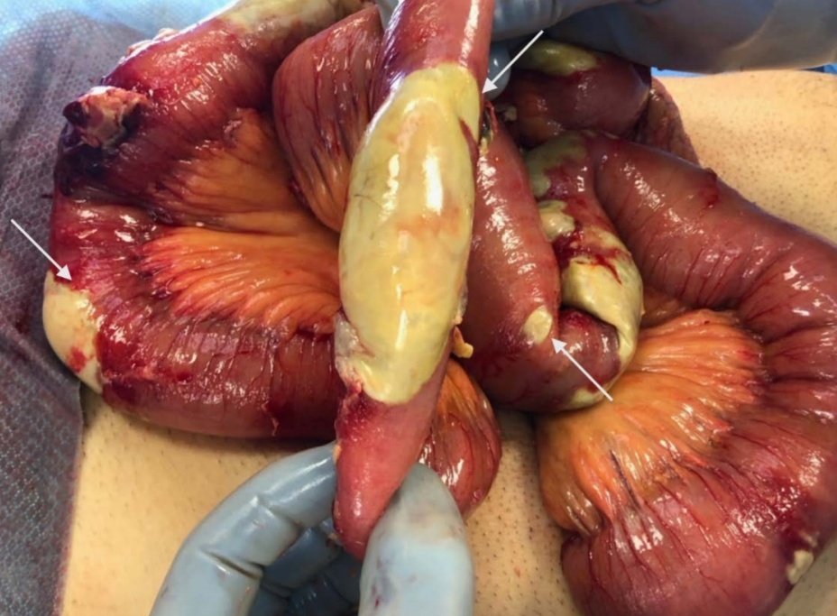 almagoch's tweet photo. El @MassGeneralNews presenta en el @AnnalsofSurgery, una serie de 141 pacientes graves x #Covid_19 
1. 45% sintomas gastrointestinales como diarrea, náuseas y vómito a inicio.
2. Ileo (55%), Ogilvie (2) y parches de necrosis intestinal x microtrombosis (2)
#Cirugía #Cirujanos https://t.co/Y8u45wRxO1