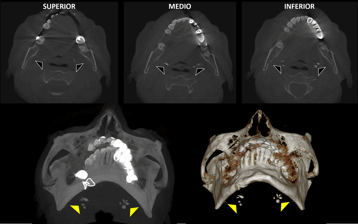 dentometric's tweet photo. Las imágenes muestran un hallazgo tomográfico compatible con calcificaciones a nivel de las amígdalas palatinas, conocidas como tonsilolitos.
#tonsilolitos #amigdalaspalatinas #cbct #radiologiamaxilofacial
Enlace: https://t.co/ZFpWVwRliT https://t.co/eVwTnMjIMr