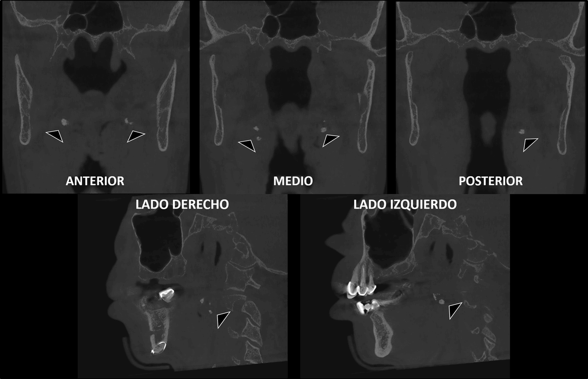 dentometric's tweet photo. Las imágenes muestran un hallazgo tomográfico compatible con calcificaciones a nivel de las amígdalas palatinas, conocidas como tonsilolitos.
#tonsilolitos #amigdalaspalatinas #cbct #radiologiamaxilofacial
Enlace: https://t.co/ZFpWVwRliT https://t.co/eVwTnMjIMr