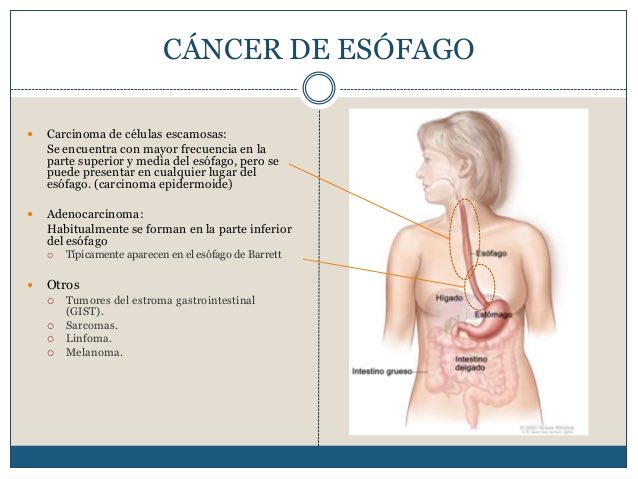 Tiene cura el cáncer de esófago Tiene cura el cáncer de esófago