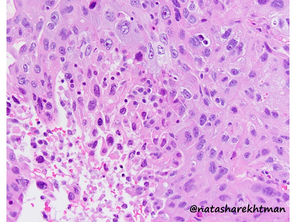 Hi pathology friends! Lung pathology is on everyone’s minds these days… but lets talk about a different type of  #pulmpath issue. Lung mass in a 60-yo patients. Core bx. What is your favored Dx on H&E? Would you just call it or get any stains?   #natpathpuzzler  @PulmPathSoc