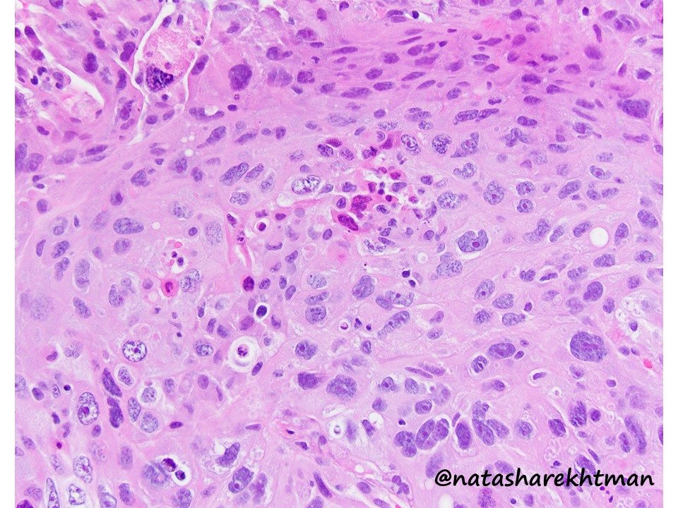 Hi pathology friends! Lung pathology is on everyone’s minds these days… but lets talk about a different type of  #pulmpath issue. Lung mass in a 60-yo patients. Core bx. What is your favored Dx on H&E? Would you just call it or get any stains?   #natpathpuzzler  @PulmPathSoc
