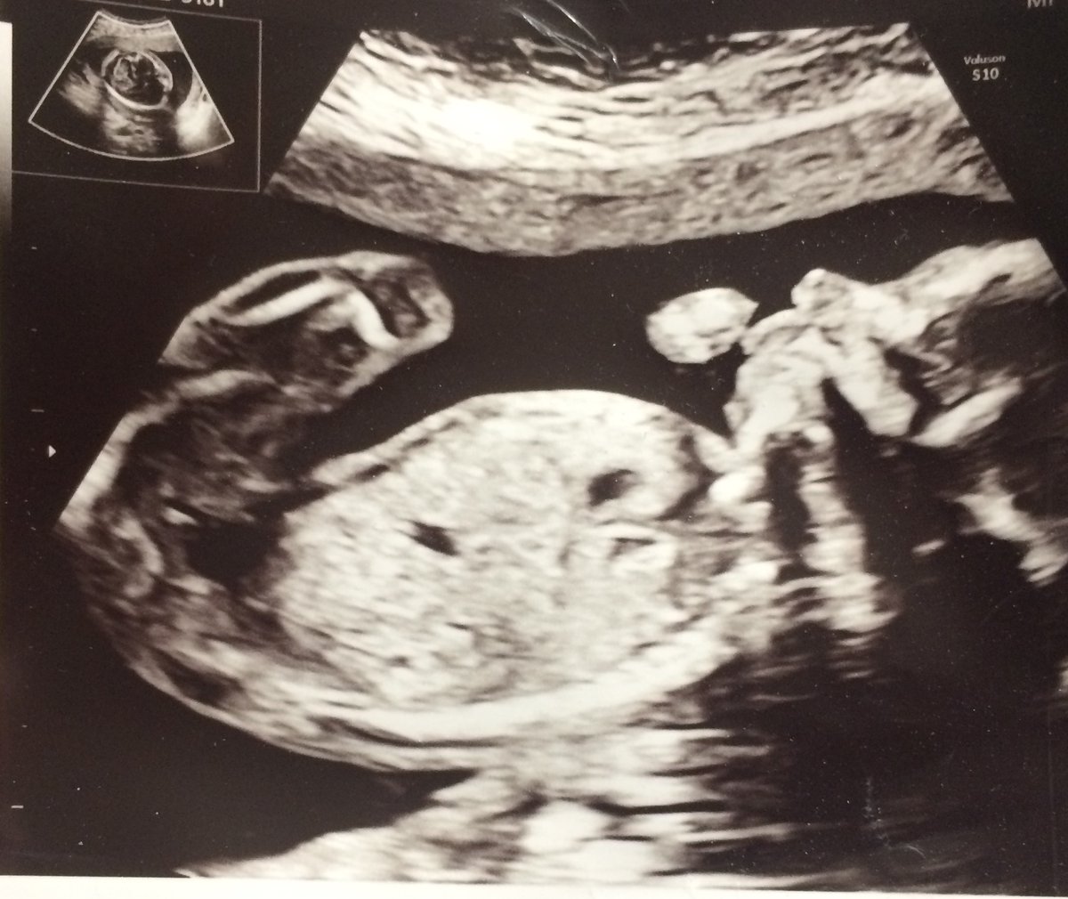 fetal_uk's tweet image. Baby @ #20weeks #pregnancy 😍

🧠You'll be having an #anatomyscan soon - this is a detailed check of baby's body, such as brain &amp;amp; kidneys
💪You should start feeling baby's jabs &amp;amp; kicks soon, if you're not already
👍Baby may try and suck her thumb

#factfriday #fetalmedicineuk
