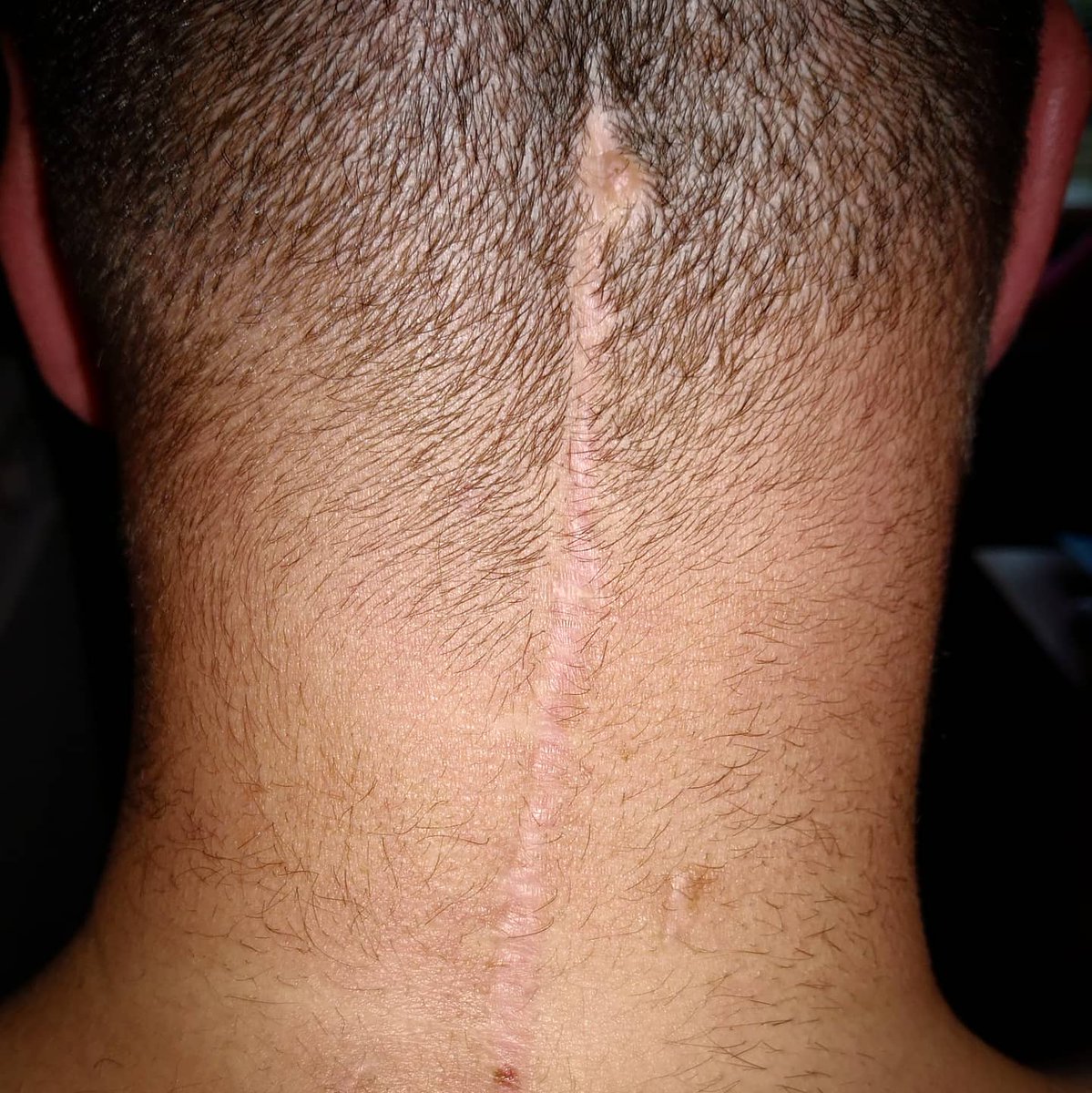 martintomlinson's tweet photo. It's my 3 year #zipperversary! A 7 hour surgery to remove a chunk of skull to free my brain, lift my head an inch and bolt it where it should be. It allowed me to walk, talk, think and be pain-free. To be a dad. To follow my dreams #chiari #EhlersDanlos #craniocervicalinstability https://t.co/PmMGnN8ot1