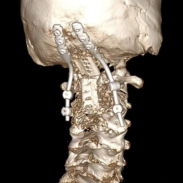 martintomlinson's tweet photo. It's my 3 year #zipperversary! A 7 hour surgery to remove a chunk of skull to free my brain, lift my head an inch and bolt it where it should be. It allowed me to walk, talk, think and be pain-free. To be a dad. To follow my dreams #chiari #EhlersDanlos #craniocervicalinstability https://t.co/PmMGnN8ot1